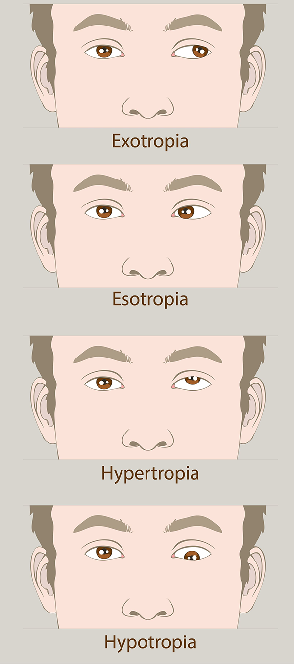 Amblyopia in Bryant Park