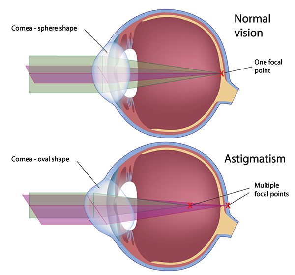 Astigmatism in Midtown East