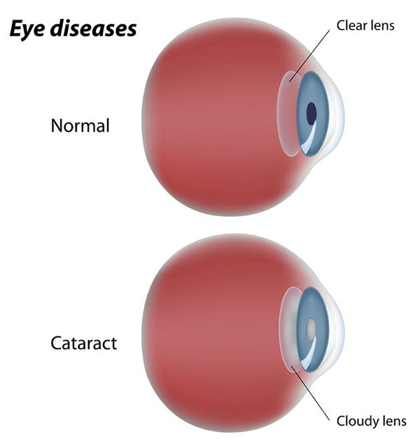 Cataract in Times Square