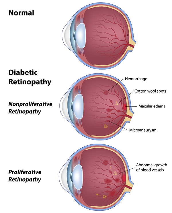 Diabetic Retinopathy in Times Square