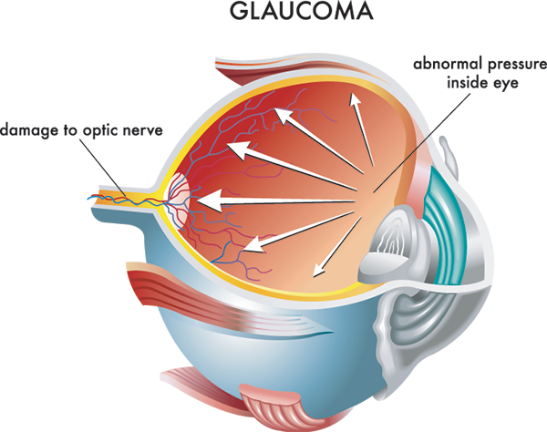 Glaucoma in Bryant Park