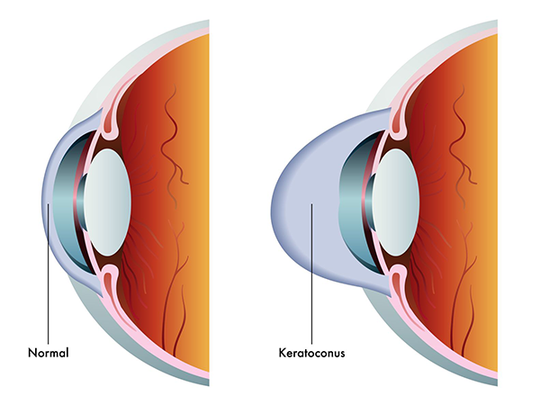 Keratoconus in Bryant Park