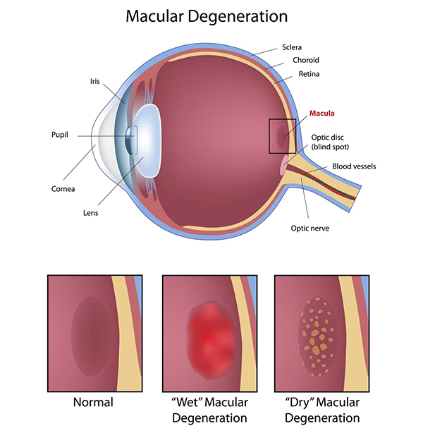 Macular Degeneration in Bryant Park