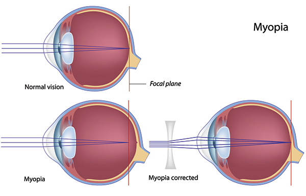 Nearsightedness in Bryant Park