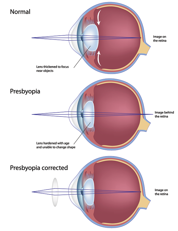 Presbyopia in Bryant Park