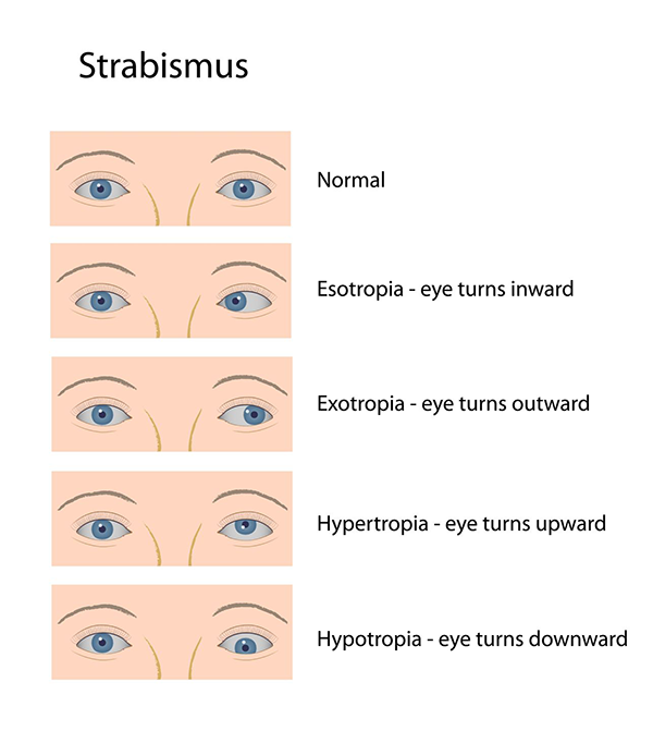 Strabismus in Bryant Park